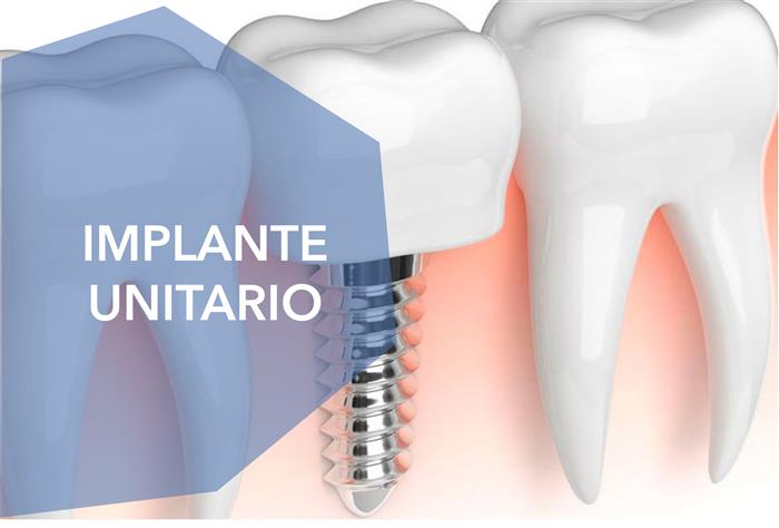 Implante unitario / Puente sobre implante